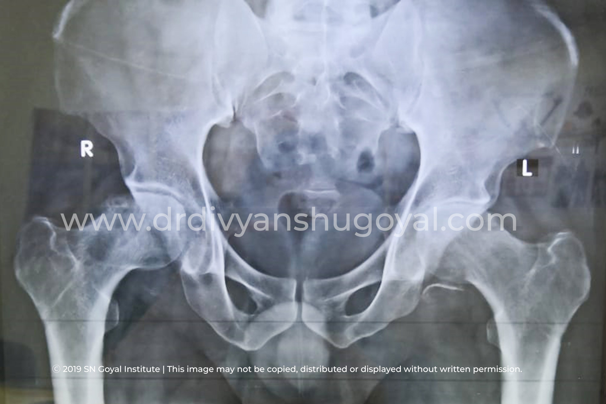 Pre Operative X-Ray